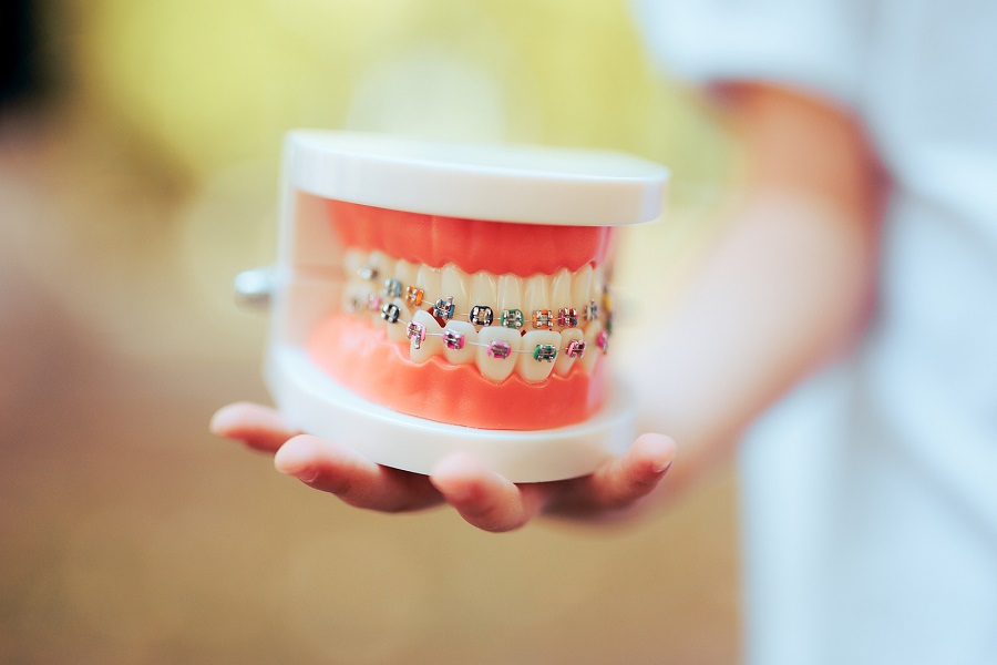 The Benefits of Braces for Children and Teens