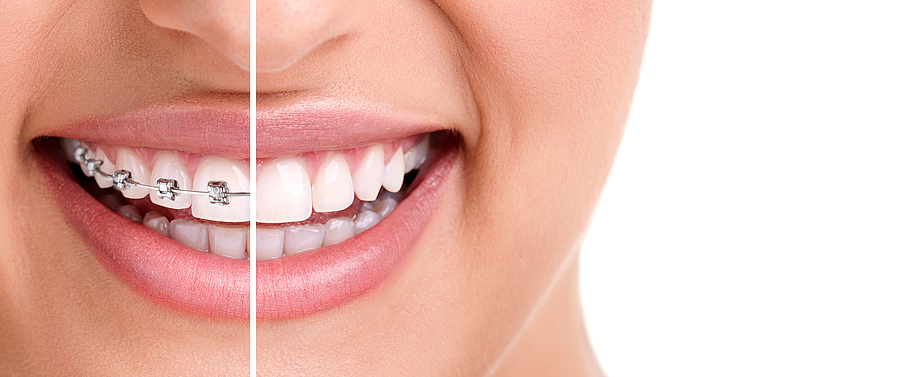 A Comprehensive Guide to Braces in Hamilton and Stevensville, MT: Achieving a Beautiful, Healthy Smile